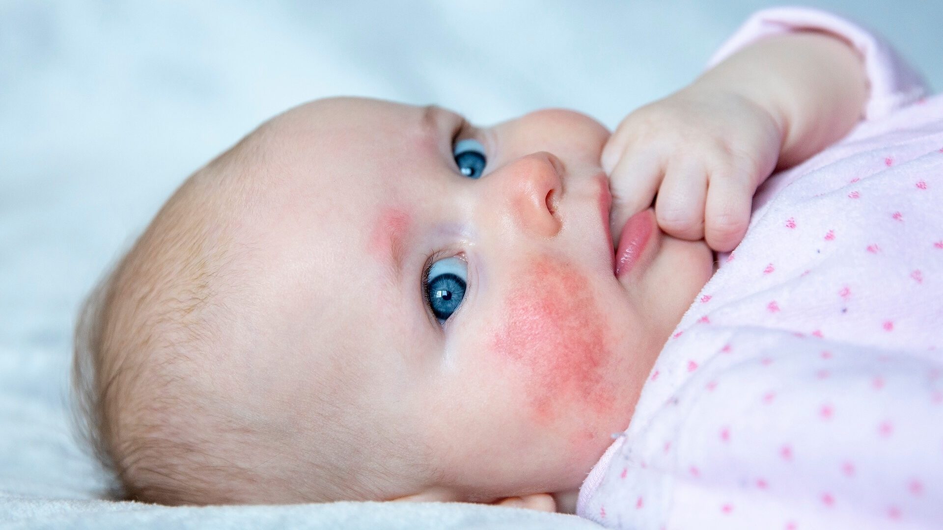 Newborn baby with allergic reaction on skin. Skin rush, detoxify.